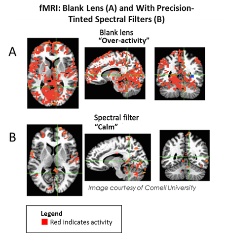 Diagrams showing brain activity. Diagram A shows a brain where the person is using a blank lens. Over-activity in the brain is represented by lots of red marks. Diagram B shows a brain where the person is using a spectral filter. Much less over-activity can be seen.